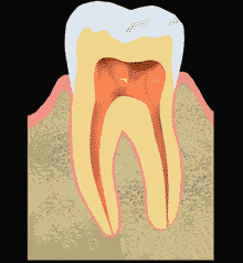 animated diagram of tooth before, during, and after root canal treatment